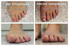 результаты до и после операции