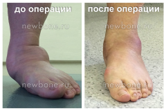 деформация стопы до операции и после операции