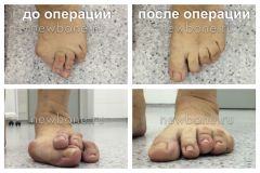 молоткообразные пальцы