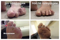 вверху до операции внизу результаты после операции